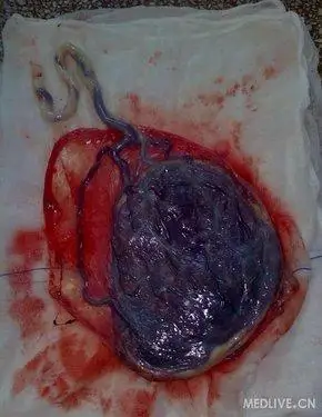 非常典型的胎盘图片