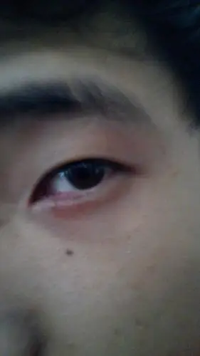 这是什么症状啊!昨天是疼,今天早上起来眼角就肿起来啦!