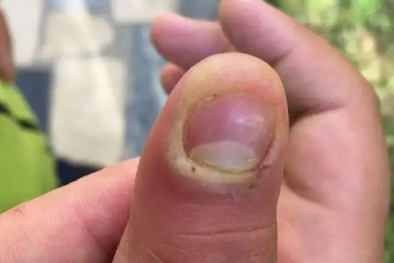 指甲根部红肿疼痛图片