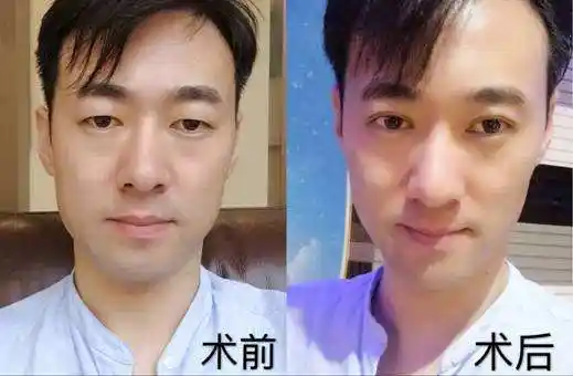 男士做双眼皮手术怎样才好看