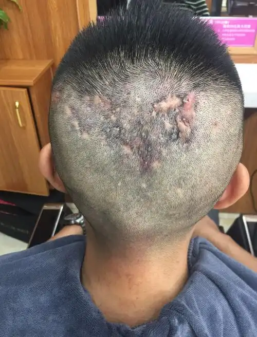 请问有头上有毛囊炎的朋友吗,怎么治好的