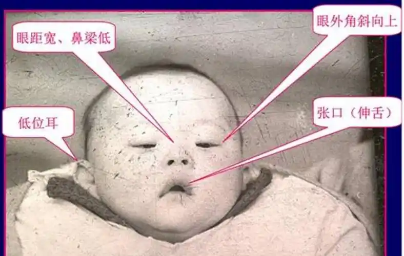 确诊21三体毅然生下来的宝宝一定是唐氏儿吗?确诊21三体高要怎么办?