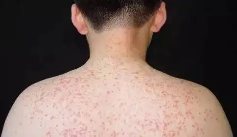 痱子皮炎还是过敏夏天的皮肤怎么了