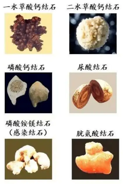 肾结石怎么吃才健康?一起来看看这篇攻略!_食物_患者_尿酸