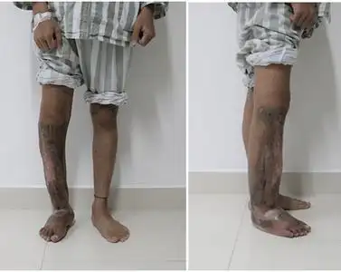 少年不慎摔一跤小腿竟黑化溃烂差点截肢原来得了这种病