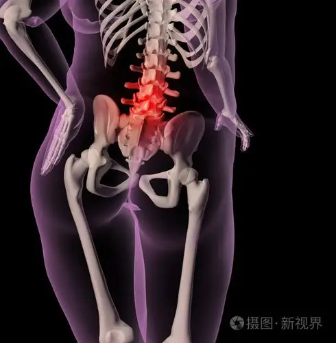 背痛的超重女性骨骼