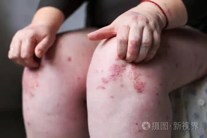 女人用手抓痒的腿.牛皮癣或湿疹皮肤