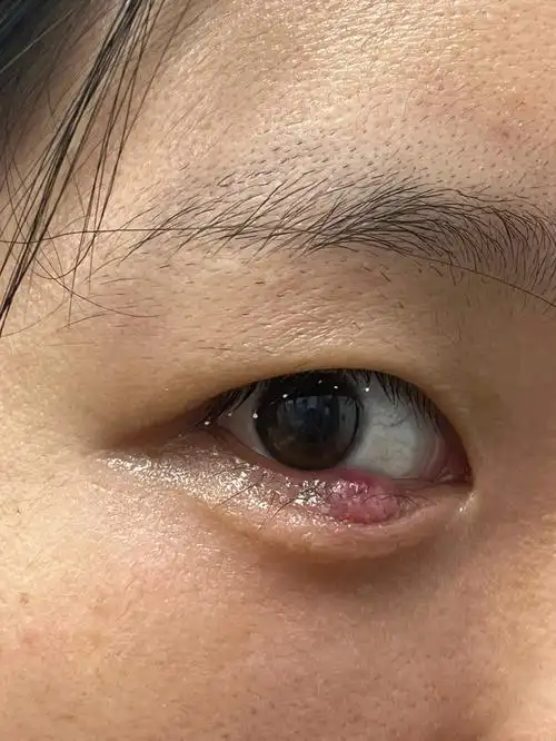 如何快速消除麦粒肿