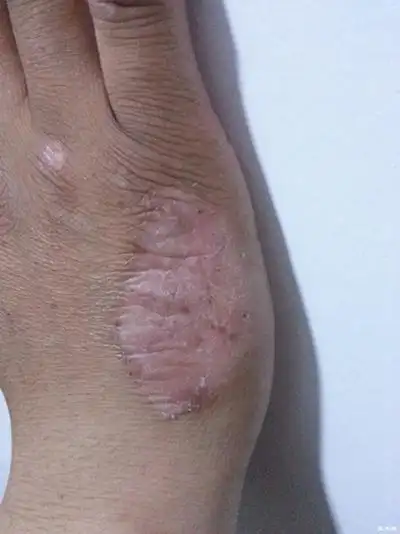 湿毒图片 (18)_有来医生