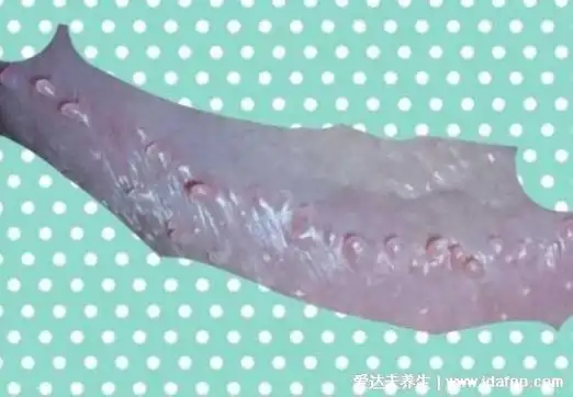 这一张是假性湿疣,也就是珍珠疹,不是x病,不会传染,也不需要特殊治疗.