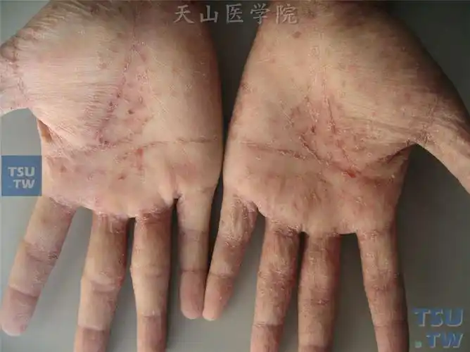 【附图】 疥疮(scabies)的症状表现 _皮肤病诊断图谱 | 天山医学院