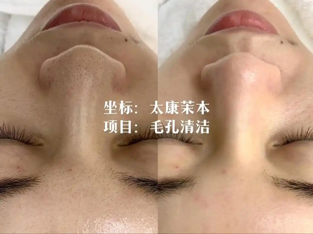 创作灵感 毛囊清洁 一次出效果能让你毛孔深层 - 抖音