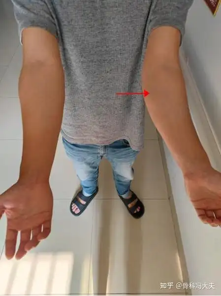 刚来的时候,左手畸形从这图可以清晰地看到左手的肘关节是明显的外翻