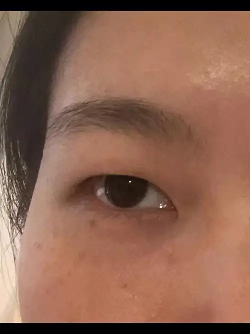 双眼皮贴对肿泡提肌无力眼有多重要