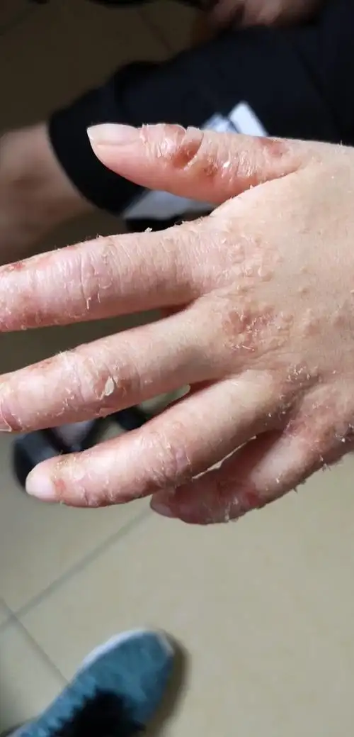 特应性皮炎是一种与遗传过敏体质有关的慢性湿疹.