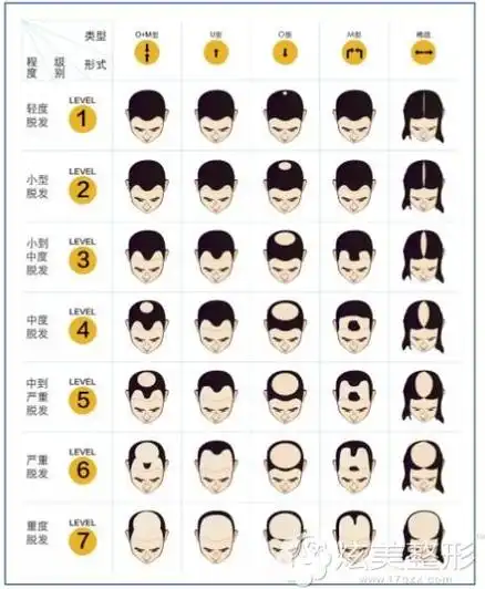 六级脱发植发效果图感谢新生植发带给90后小伙子的改变