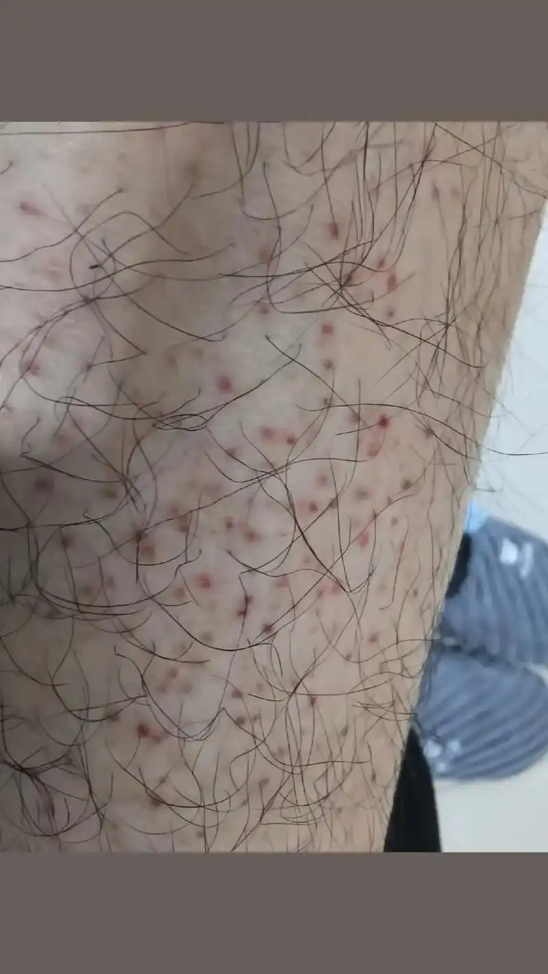 一到冬天小腿皮肤好痒,越挠越痒,抖音大神们有什么药推荐一下# - 抖音