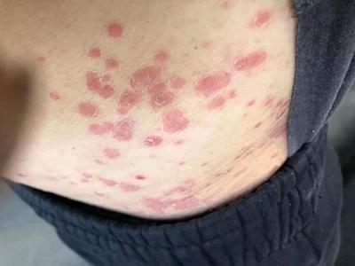 云南本草癣痒宁股藓真菌大腿内痒湿疹膏牛皮癣皮肤瘙痒特效止痒