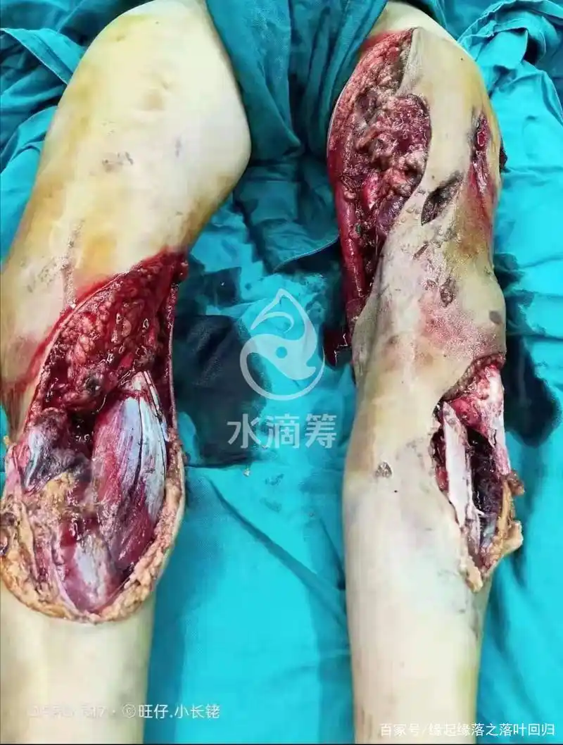 武威市柏树镇11岁的女孩急于众筹,由于货车碾压双腿,遭遇了截肢