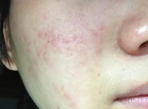 皮肤干痒起皮宝宝冬季肌肤护理知多少宝宝冬季皮肤干痒怎么办