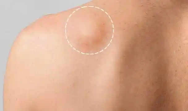 脂肪瘤的形成原因是什么,是否会有恶变可能,需要手术吗?