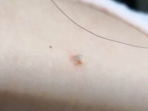 脖子上长了个瘊子,请问该怎么处置?