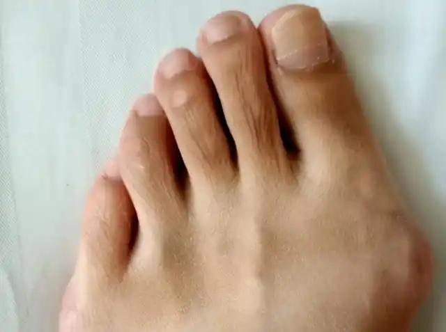 拇外翻俗称"大脚骨",通常表现为第一跖骨外偏,且表面形成滑囊,侵占第