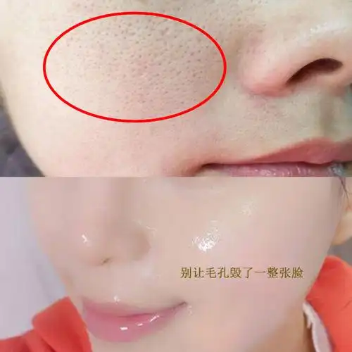 热销缩小毛孔粗大修复女_【买2送1】收缩毛孔精华液收毛孔粗大修复