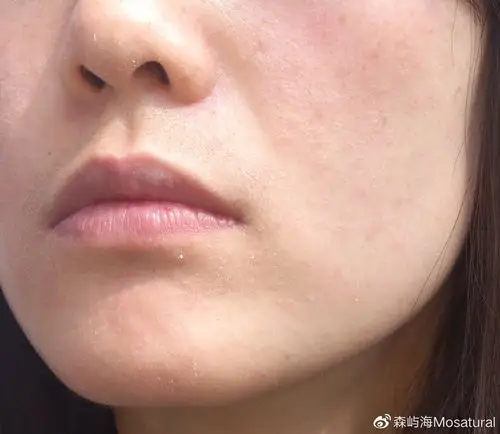 脸干死皮多干性皮肤冬季护肤需要注意这几点