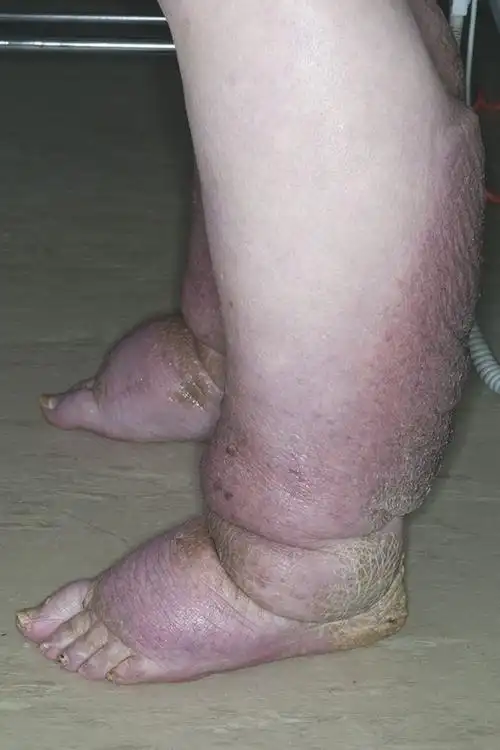 如此这般的象皮腿你见过吗