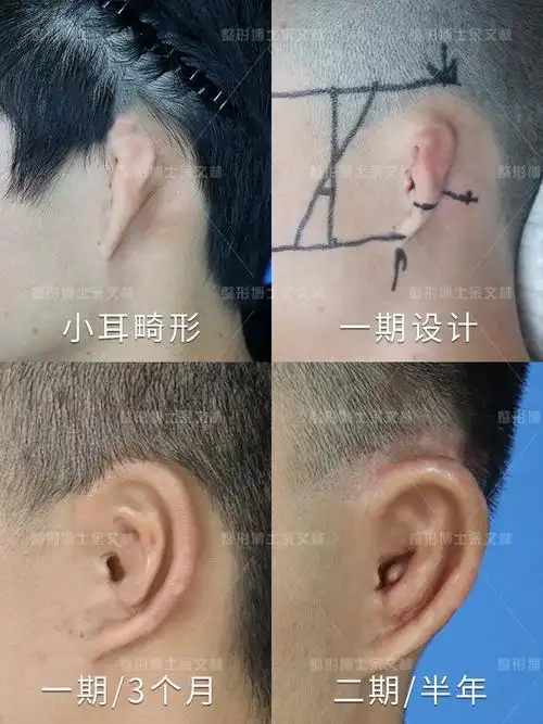 重度杯状耳但无论是轻度,还是重度杯状耳,首要原则就是升高耳轮脚位置