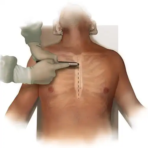 纵劈胸骨正中开胸示意图图7. 胸骨内固定术示意图图8.