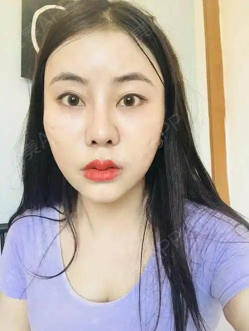 自体脂肪填泪沟术后15天_自体脂肪面部填充术后15天_面部填充术后15天