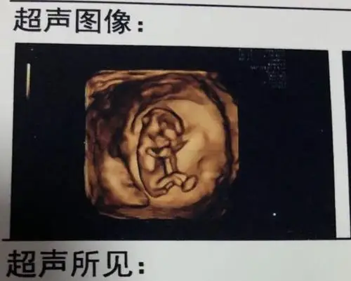 12周nt小尾巴看男女医生与性别关系不大