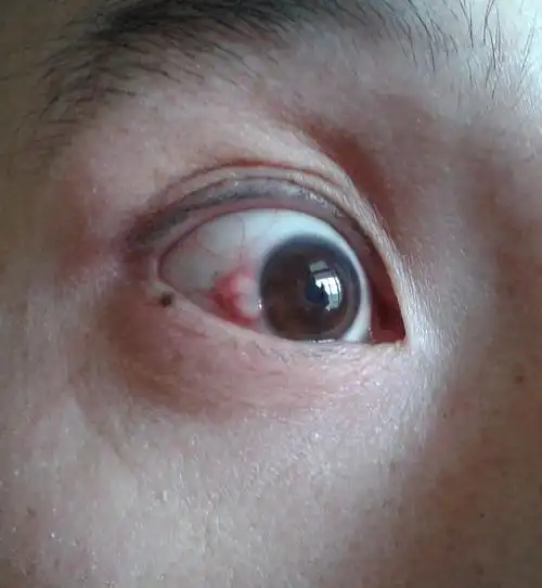 这是什么病眼睛长泡