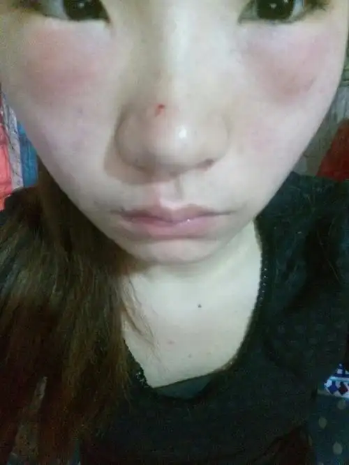 半夜眼睛下方也就是眼袋的位置开始有点痒!