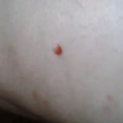 问:大腿的皮肤上长了个黄豆大小的肉球,请问是什么