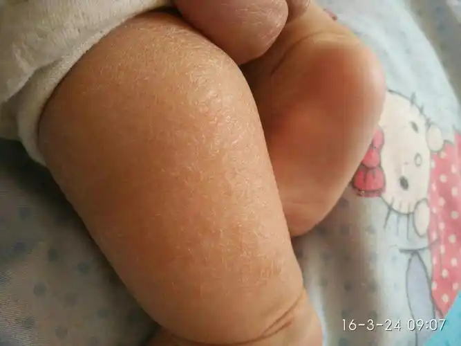 宝宝三个月皮肤干燥开裂,以前是一点,现在小腿一大片,这怎么回事,麻烦