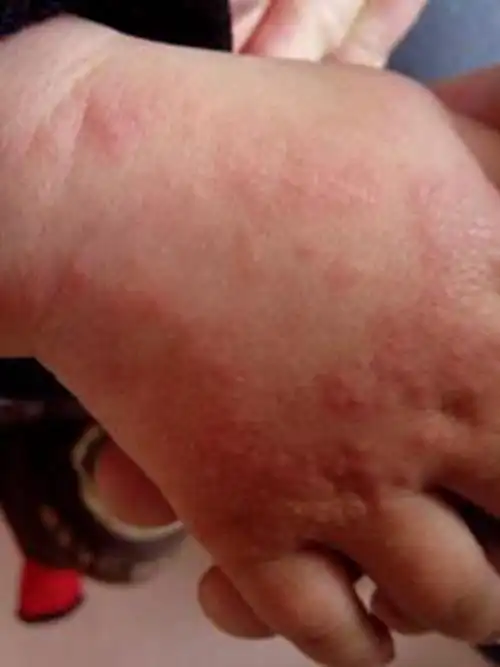 手部湿疹图片