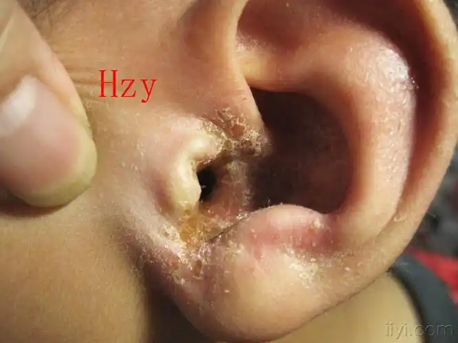 外耳及面部皮损公布答案传染性湿疹样皮炎