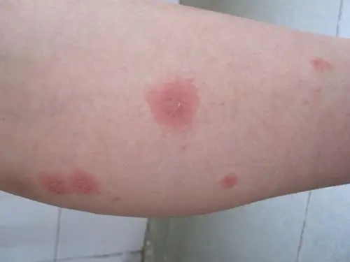 米粒大丘疹长成大红斑-多形红斑型药疹 - 皮肤及性传播疾病讨论版