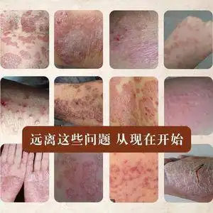 皮肤病专用治疗牛皮止痒湿疹汗疱疹手癣膏真菌感染脚藓癣去根药膏