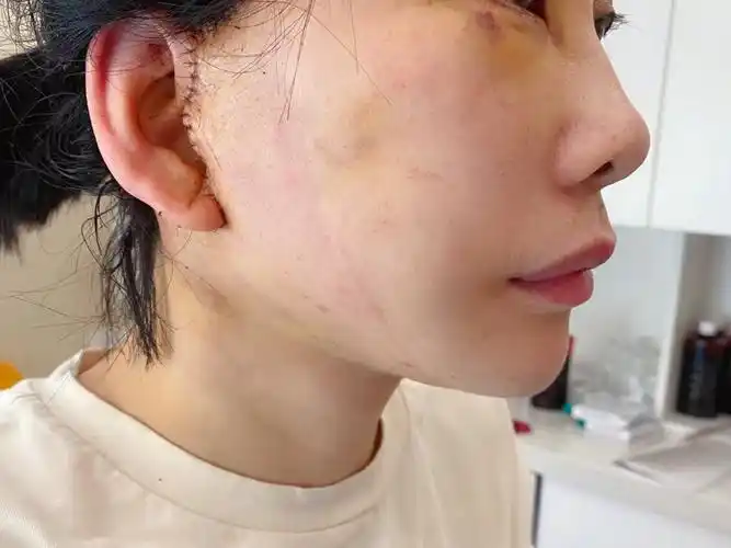 97脸小一圈的体验,迷你拉皮术后七天对比91接触的整形_圈子-新氧