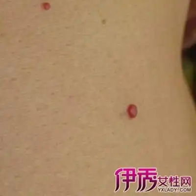 艾滋病起什么样的疙瘩疙瘩种类多且万万不能挠