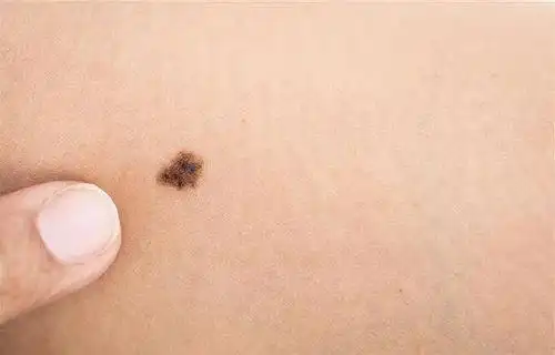 当然也有少部分比较少见的痣没有颜色,比如无色素痣,贫血痣,这些都不