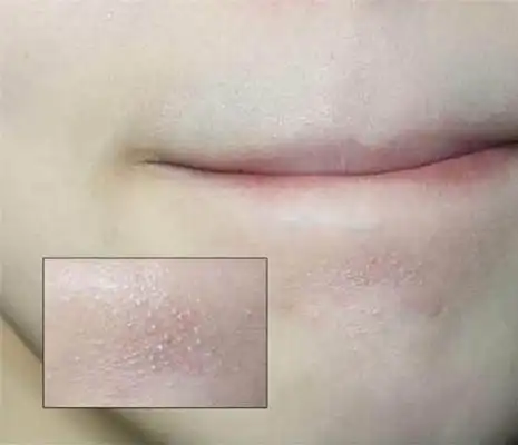 闭口粉刺图 (76)