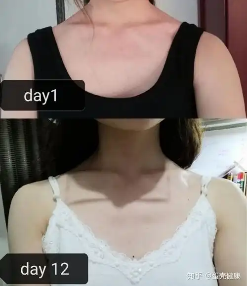 女生肩膀的上斜方肌太粗壮了怎么办