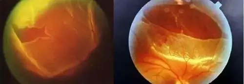 内有福利高度近视真会瞎额我市首个高度近视眼门诊成立