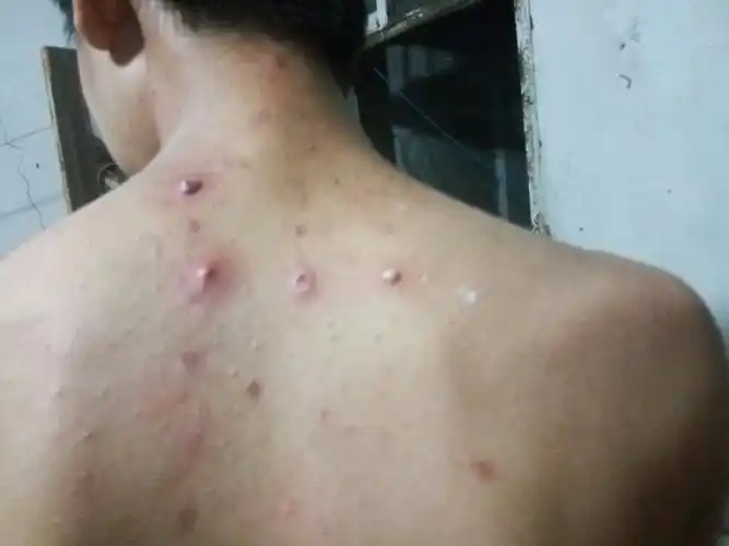 背上的痘怎么弄? 求大神