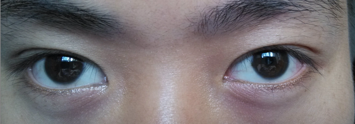 医生好我双眼上眼皮浮肿已经有两年了去三家医院看过检查都说